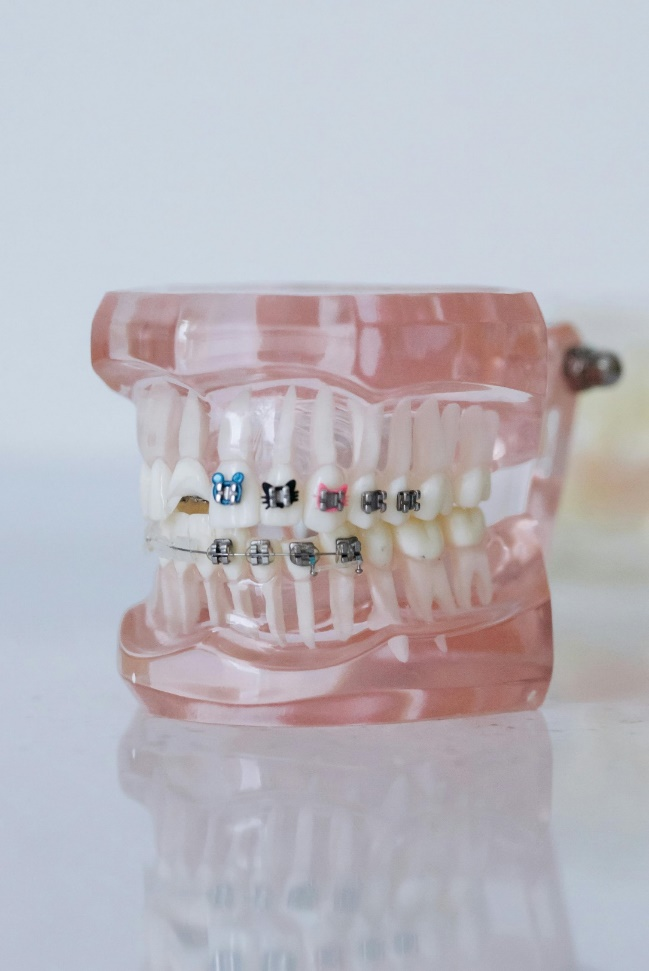 Dentures with braces