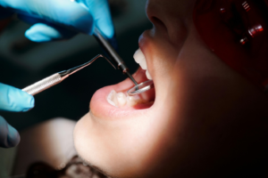 an open mouth being inspected by dentist tools